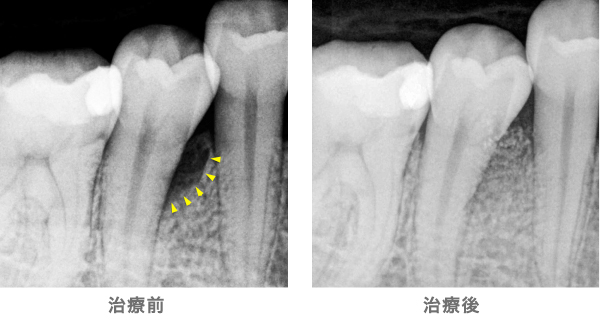 歯周組織再生治療の例